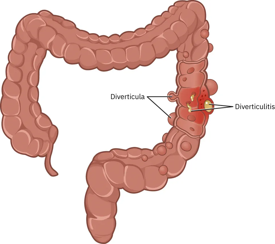 Diverticulosis/diverticulitis: verzwakkingen in de darmwand met uitstulping naar buiten toe tot gevolg. Deze kunnen ontsteken, bloeden of perforeren.